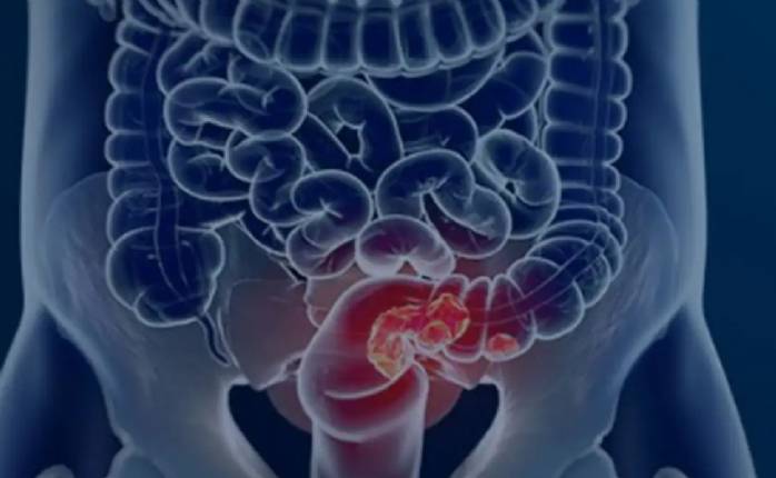 Pacientes com câncer colorretal são diagnosticados em estágio avançado>