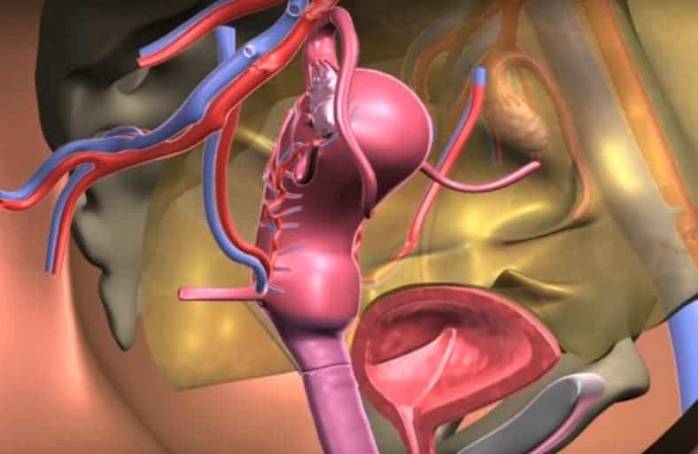 Transplante uterino como alternativa para mulheres com Síndrome de Rokitansky