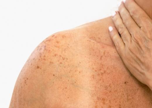 Dezembro Laranja chama a atenção para a prevenção ao câncer de pele