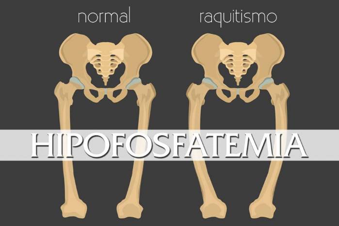 Raquitismo hipofosfatêmico ligado ao cromossomo X: doença rara requer atenção
