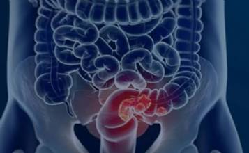 Pacientes com câncer colorretal são diagnosticados em estágio avançado
